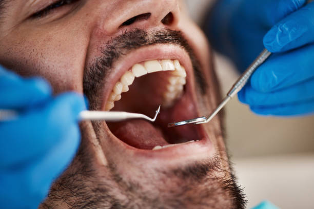 Best Wisdom Tooth Removal  in San Felipe, TX